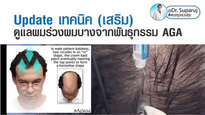 Update เทคนิค (เสริม)ดูแลผมร่วงผมบางจากพันธุกรรม AGA